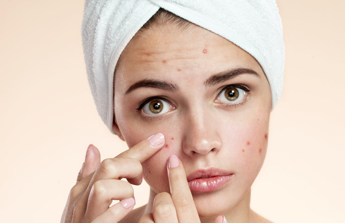 How to deal with acne prone skin?